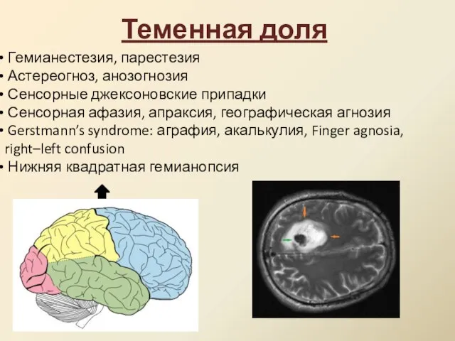 Теменная доля Гемианестезия, парестезия Астереогноз, анозогнозия Сенсорные джексоновские припадки Сенсорная афазия,