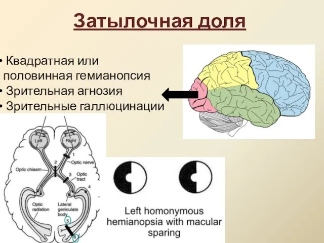 Затылочная доля Квадратная или половинная гемианопсия Зрительная агнозия Зрительные галлюцинации