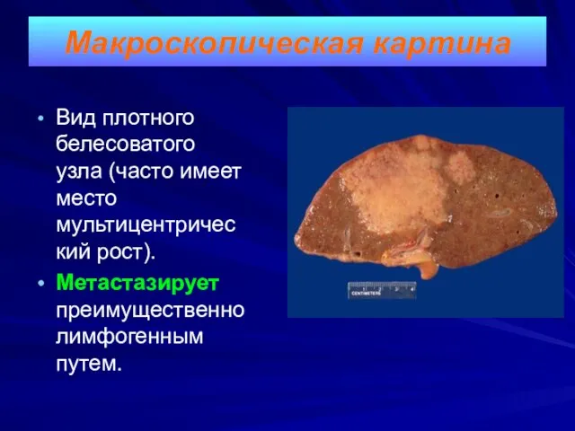 Макроскопическая картина Вид плотного белесоватого узла (часто имеет место мультицентрический рост). Метастазирует преимущественно лимфогенным путем.