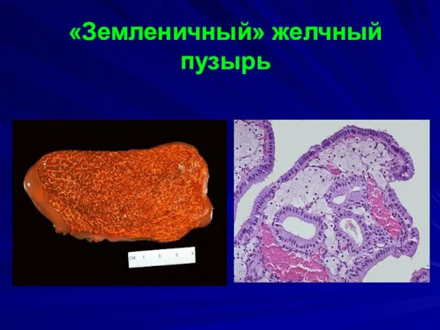 «Земленичный» желчный пузырь