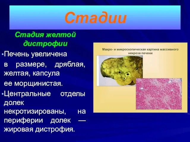 Стадия желтой дистрофии Печень увеличена в размере, дряблая, желтая, капсула ее