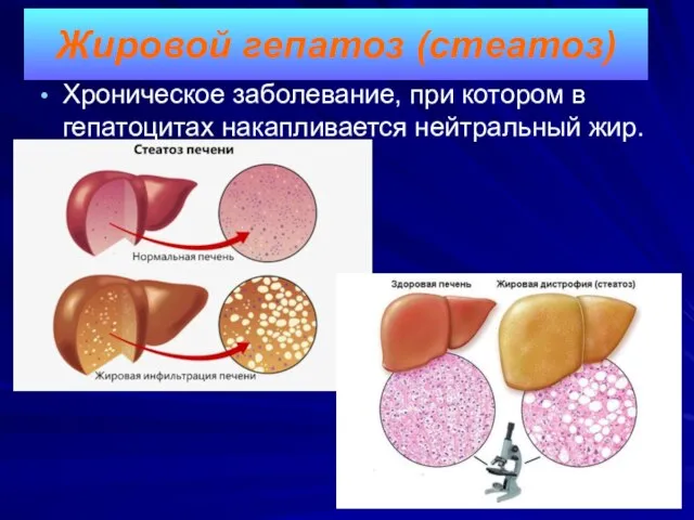 Хроническое заболевание, при котором в гепатоцитах накапливается нейтральный жир. Жировой гепатоз (стеатоз)