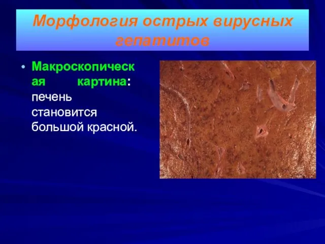 Морфология острых вирусных гепатитов Макроскопическая картина: печень становится большой красной.