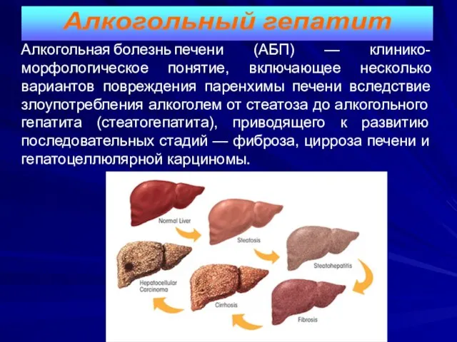 Алкогольная болезнь печени (АБП) — клинико-морфологическое понятие, включающее несколько вариантов повреждения