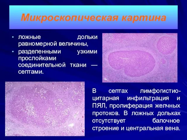 Микроскопическая картина ложные дольки равномерной величины, разделенными узкими прослойками соединительной ткани