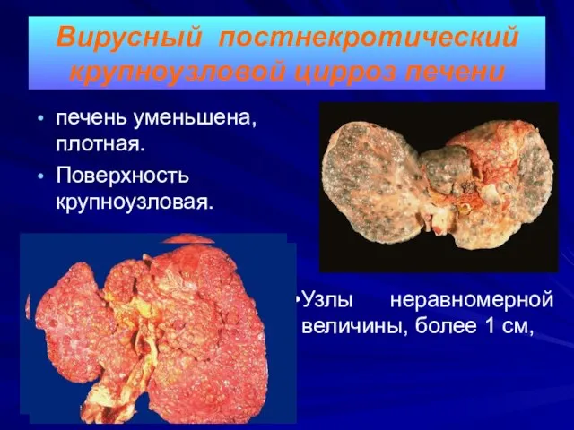 Вирусный постнекротический крупноузловой цирроз печени печень уменьшена, плотная. Поверхность крупноузловая. Узлы неравномерной величины, более 1 см,