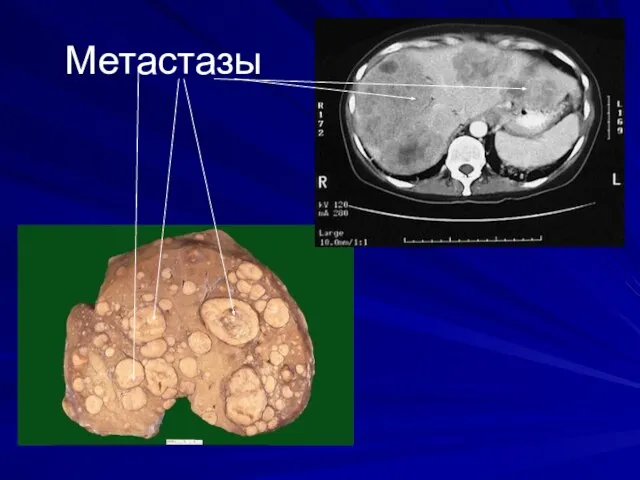 Метастазы