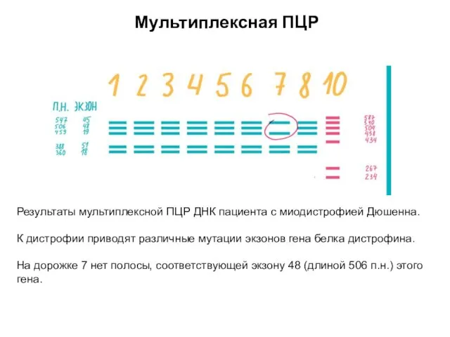 Мультиплексная ПЦР Результаты мультиплексной ПЦР ДНК пациента с миодистрофией Дюшенна. К