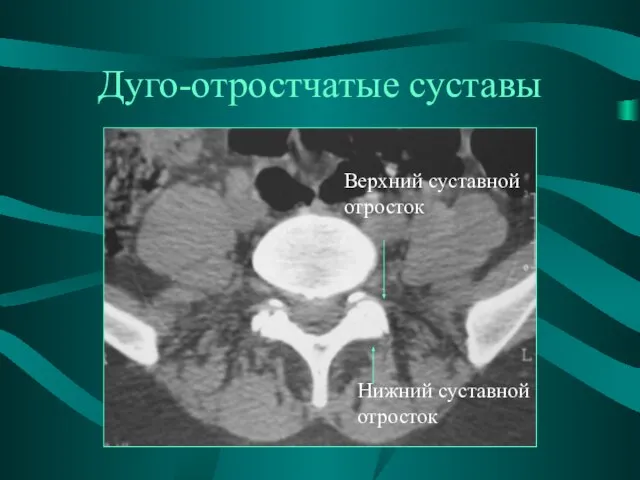 Дуго-отростчатые суставы Верхний суставной отросток Нижний суставной отросток