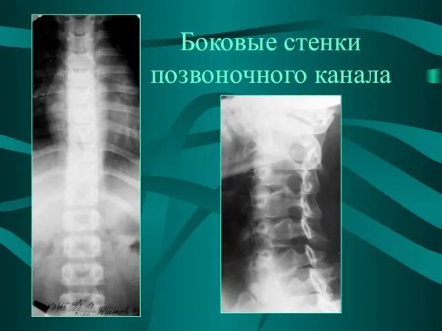 Боковые стенки позвоночного канала