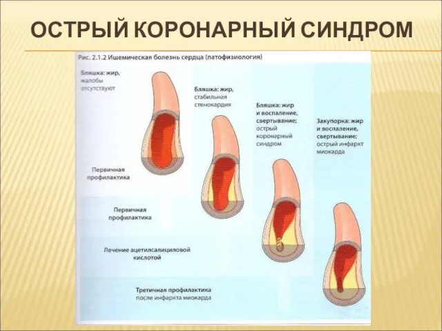 ОСТРЫЙ КОРОНАРНЫЙ СИНДРОМ