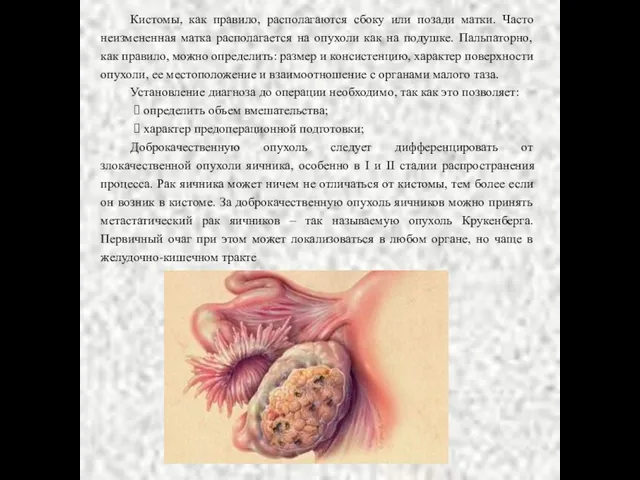 Кистомы, как правило, располагаются сбоку или позади матки. Часто неизмененная матка