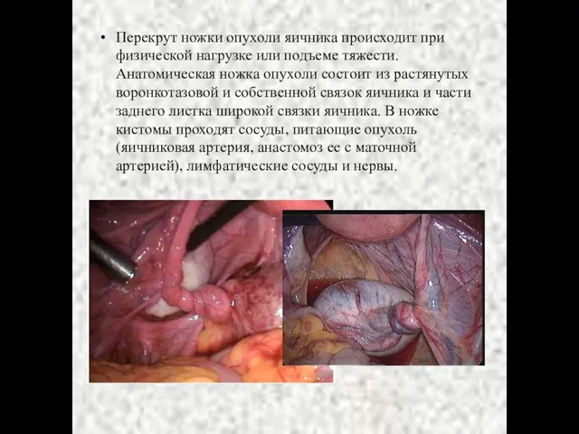 Перекрут ножки опухоли яичника происходит при физической нагрузке или подъеме тяжести.