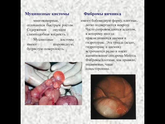 Муцинозные кистомы многокамерные, отличаются быстрым ростом. Содержимое опухоли – слизеподобная жидкость.