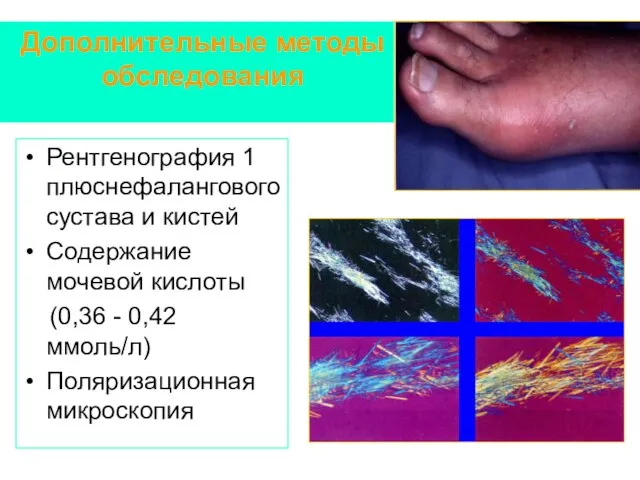 Дополнительные методы обследования Рентгенография 1 плюснефалангового сустава и кистей Содержание мочевой