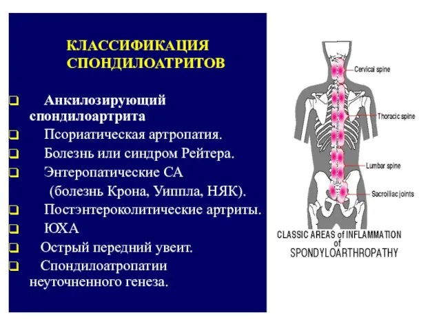 КЛАССИФИКАЦИЯ СПОНДИЛОАТРИТОВ Анкилозирующий спондилоартрита Псориатическая артропатия. Болезнь или синдром Рейтера. Энтеропатические