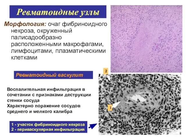 Ревматоидные узлы Морфология: очаг фибриноидного некроза, окруженный палисадообразно расположенными макрофагами, лимфоцитами,