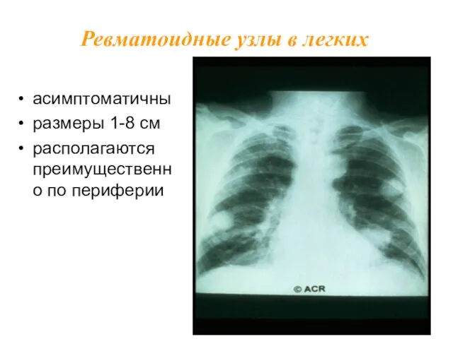 асимптоматичны размеры 1-8 см располагаются преимущественно по периферии Ревматоидные узлы в легких