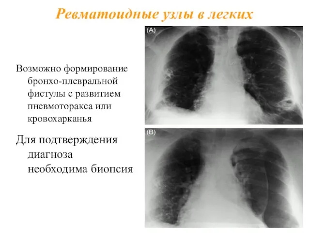 Возможно формирование бронхо-плевральной фистулы с развитием пневмоторакса или кровохарканья Для подтверждения