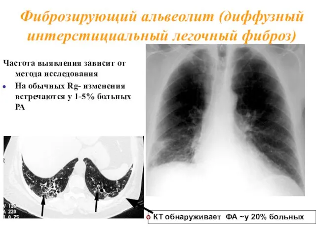 Частота выявления зависит от метода исследования На обычных Rg- изменения встречаются