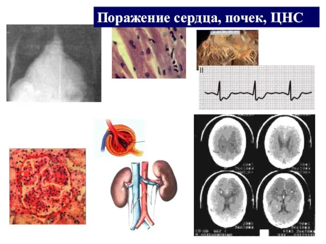 Поражение сердца, почек, ЦНС