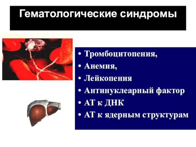 Гематологические синдромы Тромбоцитопения, Анемия, Лейкопения Антинуклеарный фактор АТ к ДНК АТ к ядерным структурам