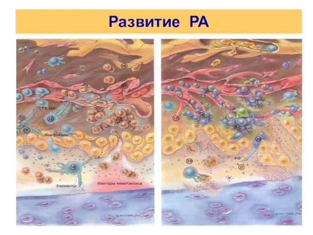 Развитие РА