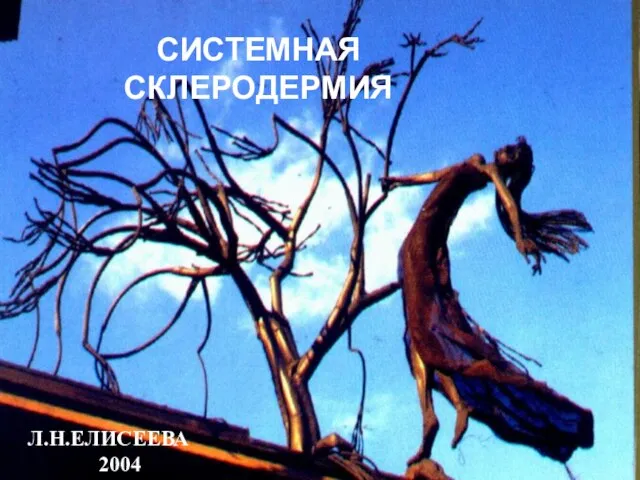 Л.Н.ЕЛИСЕЕВА 2004 СИСТЕМНАЯ СКЛЕРОДЕРМИЯ Л.Н.ЕЛИСЕЕВА 2004