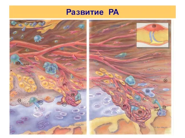 Развитие РА