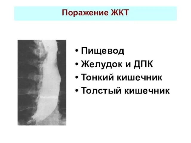 Поражение ЖКТ Пищевод Желудок и ДПК Тонкий кишечник Толстый кишечник