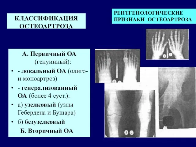 КЛАССИФИКАЦИЯ ОСТЕОАРТРОЗА А. Первичный ОА (генуинный): - локальный ОА (олиго- и