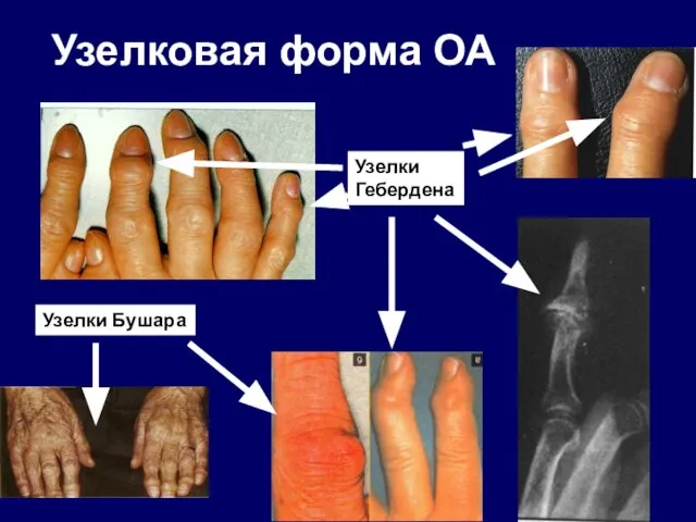 Узелковая форма ОА Узелки Бушара Узелки Гебердена