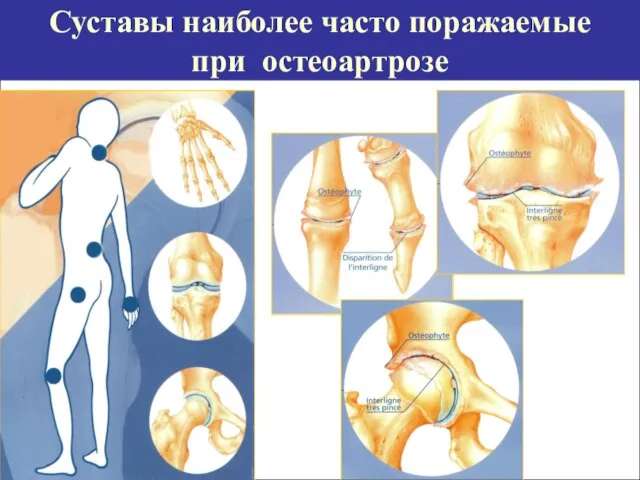 Суставы наиболее часто поражаемые при остеоартрозе