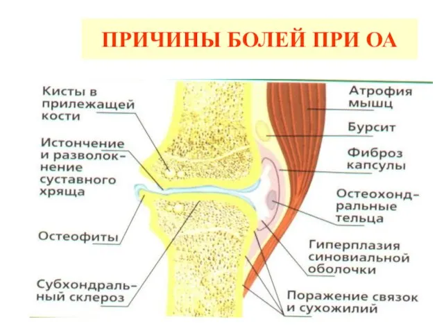 ПРИЧИНЫ БОЛЕЙ ПРИ ОА