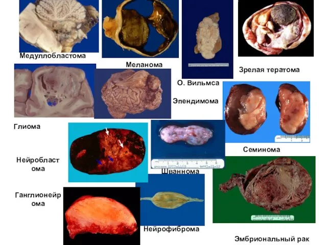 О. Вильмса Эмбриональный рак Семинома Зрелая тератома Эмбриональный рак Меланома Эпендимома
