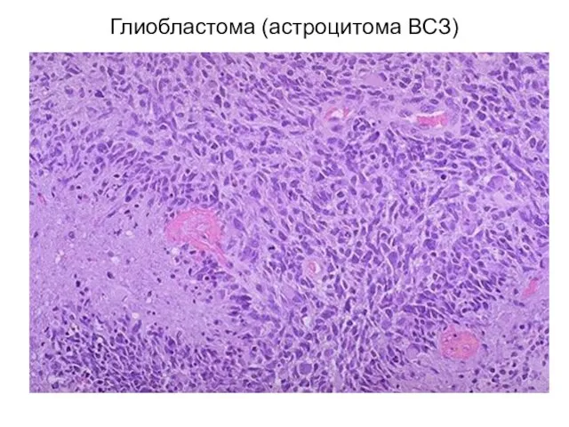 Глиобластома (астроцитома ВСЗ)