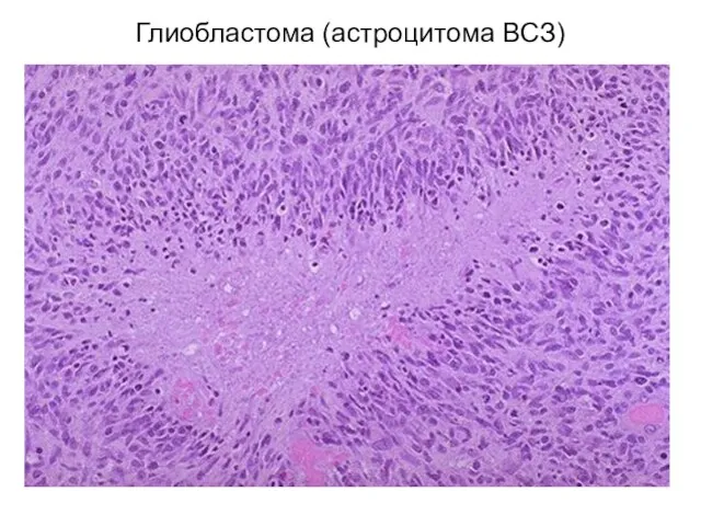 Глиобластома (астроцитома ВСЗ)