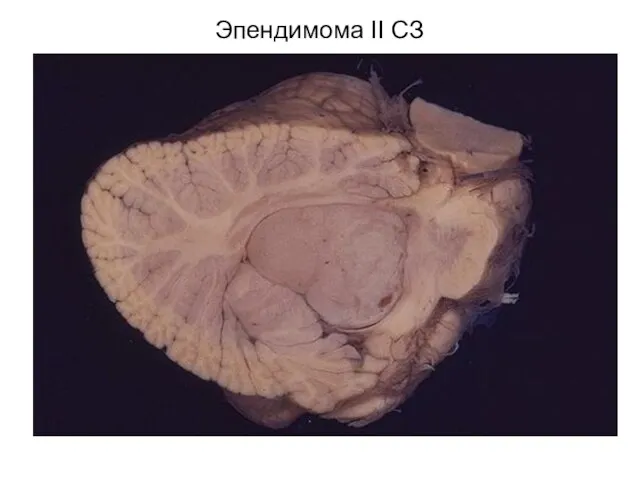 Эпендимома II СЗ