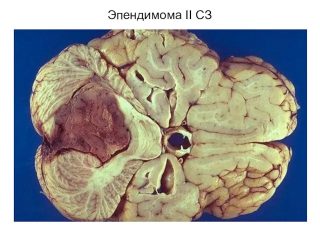 Эпендимома II СЗ