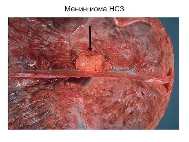 Менингиома НСЗ