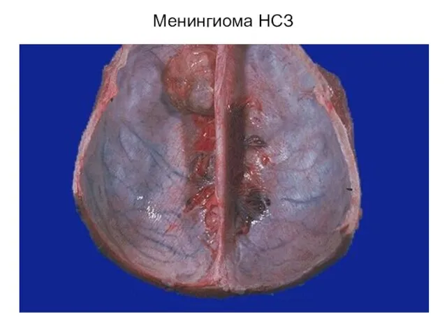 Менингиома НСЗ