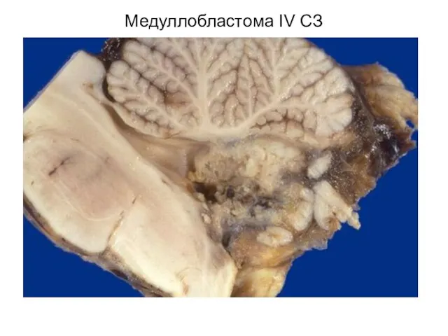 Медуллобластома IV СЗ