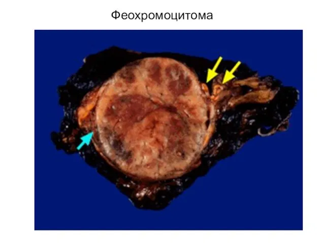 Феохромоцитома