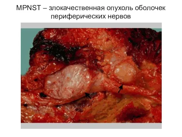 MPNST – злокачественная опухоль оболочек периферических нервов