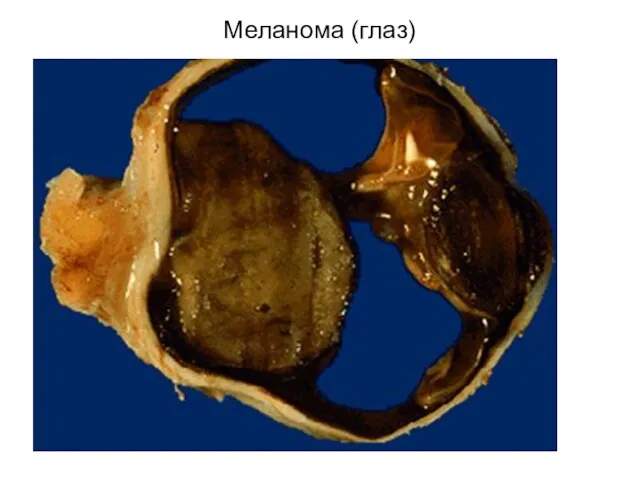 Меланома (глаз)