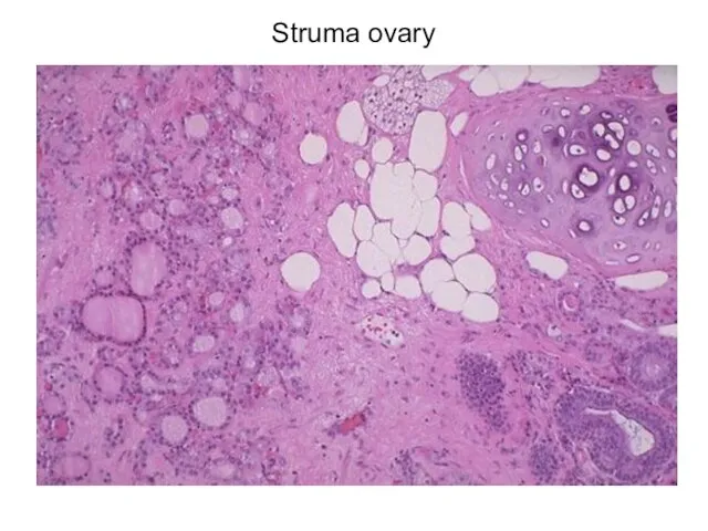 Struma ovary