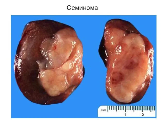 Семинома