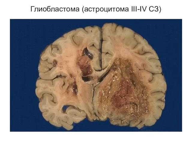 Глиобластома (астроцитома III-IV СЗ)