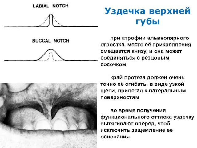 Уздечка верхней губы при атрофии альвеолярного отростка, место её прикрепления смещается