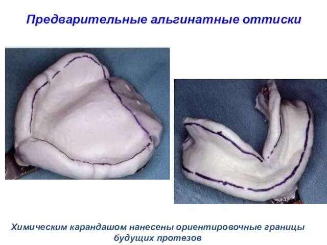 Предварительные альгинатные оттиски Химическим карандашом нанесены ориентировочные границы будущих протезов